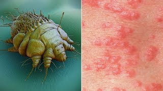 What is Scabies Causes Pictures Images Signs and Symptoms of Scabies [upl. by Etnovert]