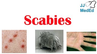 Scabies Skin Condition  What Is It Classic vs Crusted Types Signs amp Symptoms Treatment [upl. by Nnomae]