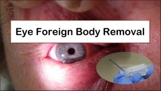 Eye Foreign Body Removal [upl. by Annette]