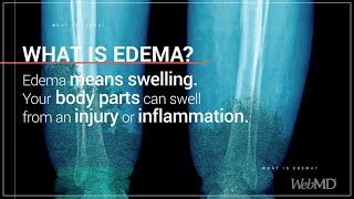 What is Edema  WebMD [upl. by Gilchrist]