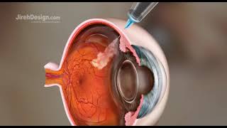 What to Expect After CATARACT SURGERY [upl. by Proud470]