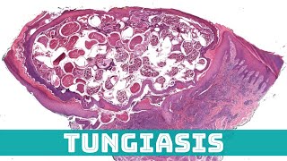 Tungiasis Sand Flea Under the Microscope Tunga penetrans aka jigger flea skin pathology [upl. by Nosredneh816]