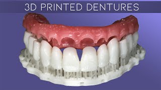 Why Digital Dentures Make Great Provisionals amp How To Characterize Digital Dentures [upl. by Aisinoid]